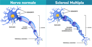 Malattia Sclerosi Multipla: patologia dal decorso cronico